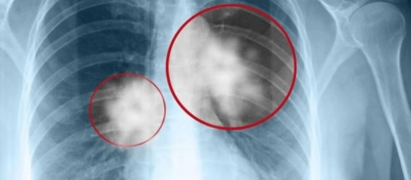 Τα πρώιμα σημάδια του καρκίνου του πνεύμονα που πρέπει να ξέρεις